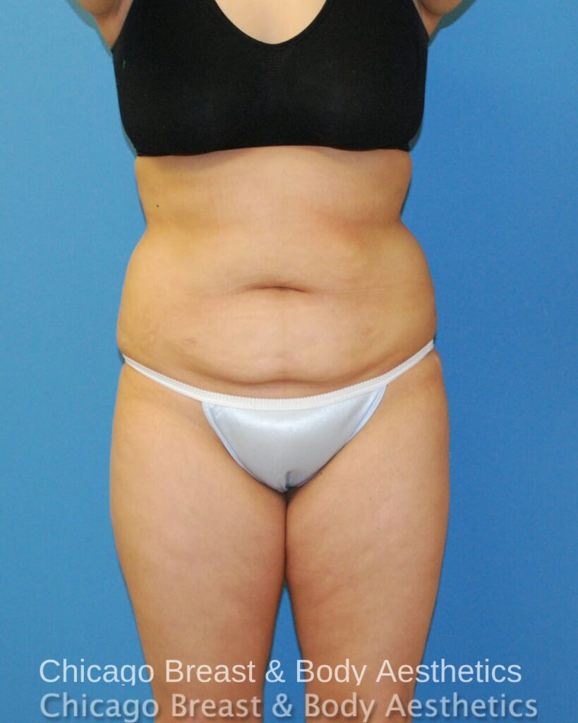 Chicago breast & body aesthetics before Full Tummy Tuck (Case #311).