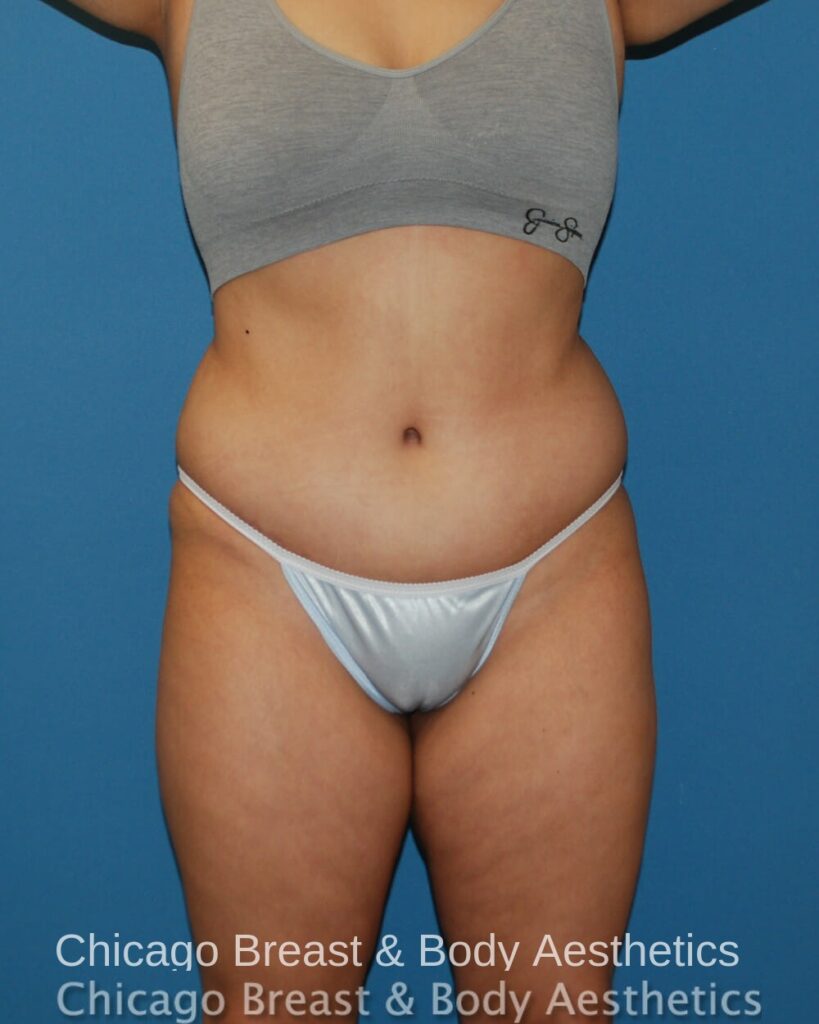 Chicago breast & body aesthetics before undergoing a full Tummy Tuck procedure.