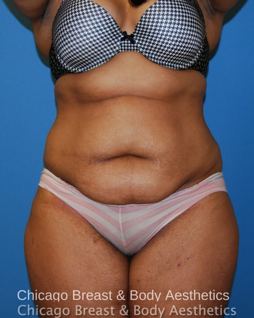 Chicago breast & body aesthetics offers full tummy tuck procedures for those seeking to enhance their body contours.