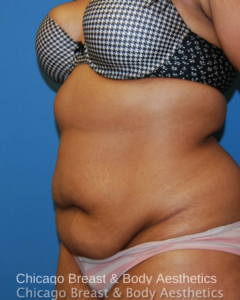 Chicago breast & body aesthetics before a Full Tummy Tuck.