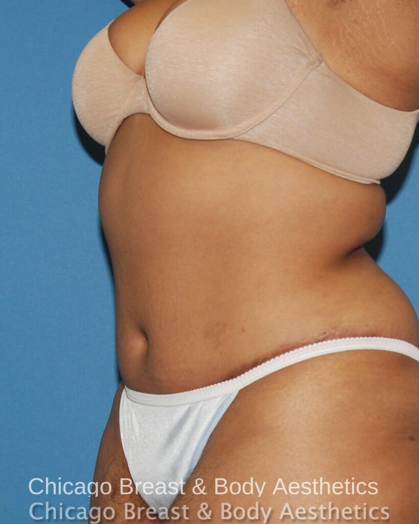 Chicago breast & body aesthetics before and after Full Tummy Tuck procedure - Case #336.