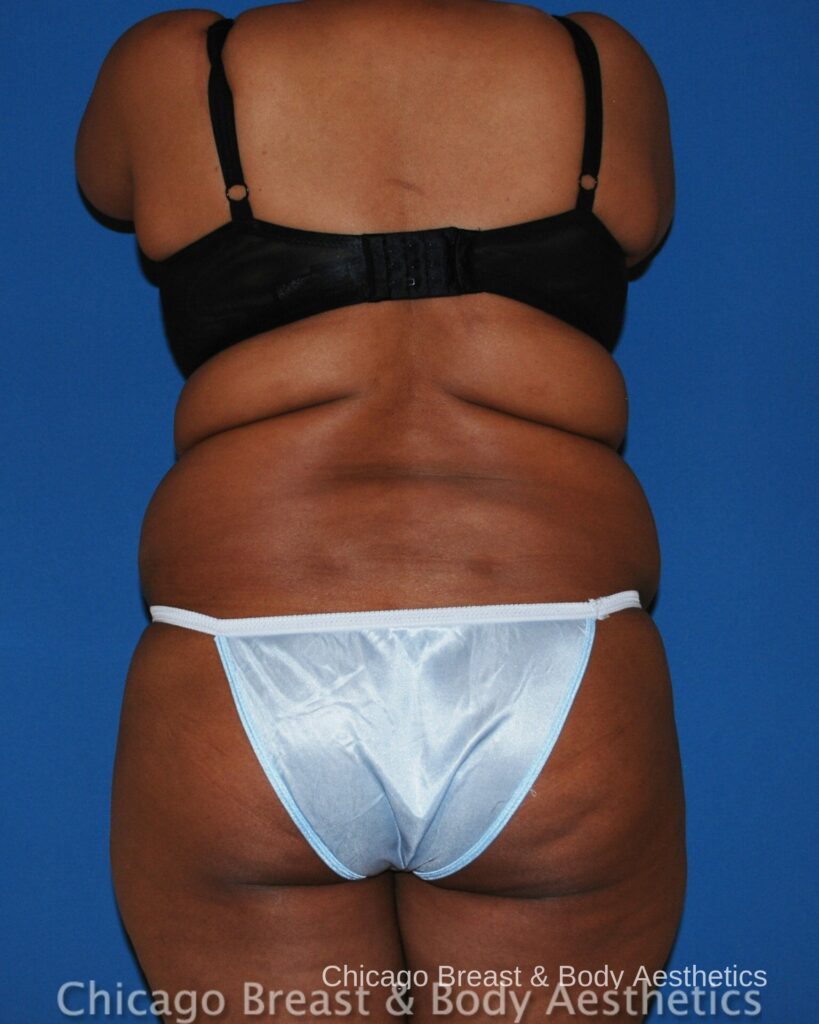 A woman in a bikini showcasing the impressive results of her tummy tuck procedure with Smartlipo. (Keywords: Smartlipo)
