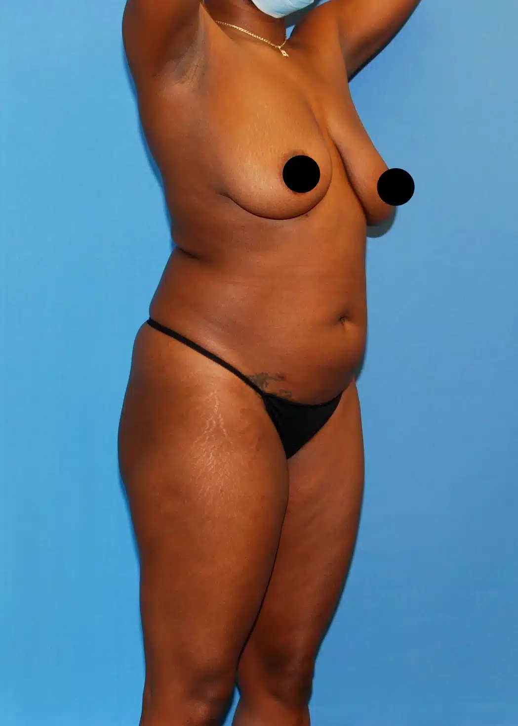 Brazilian Butt Lift, Lipo 360, Liposuction before photo 5, case #35511, Dr. Anh-Tuan Truong, Chicago Breast & Body
