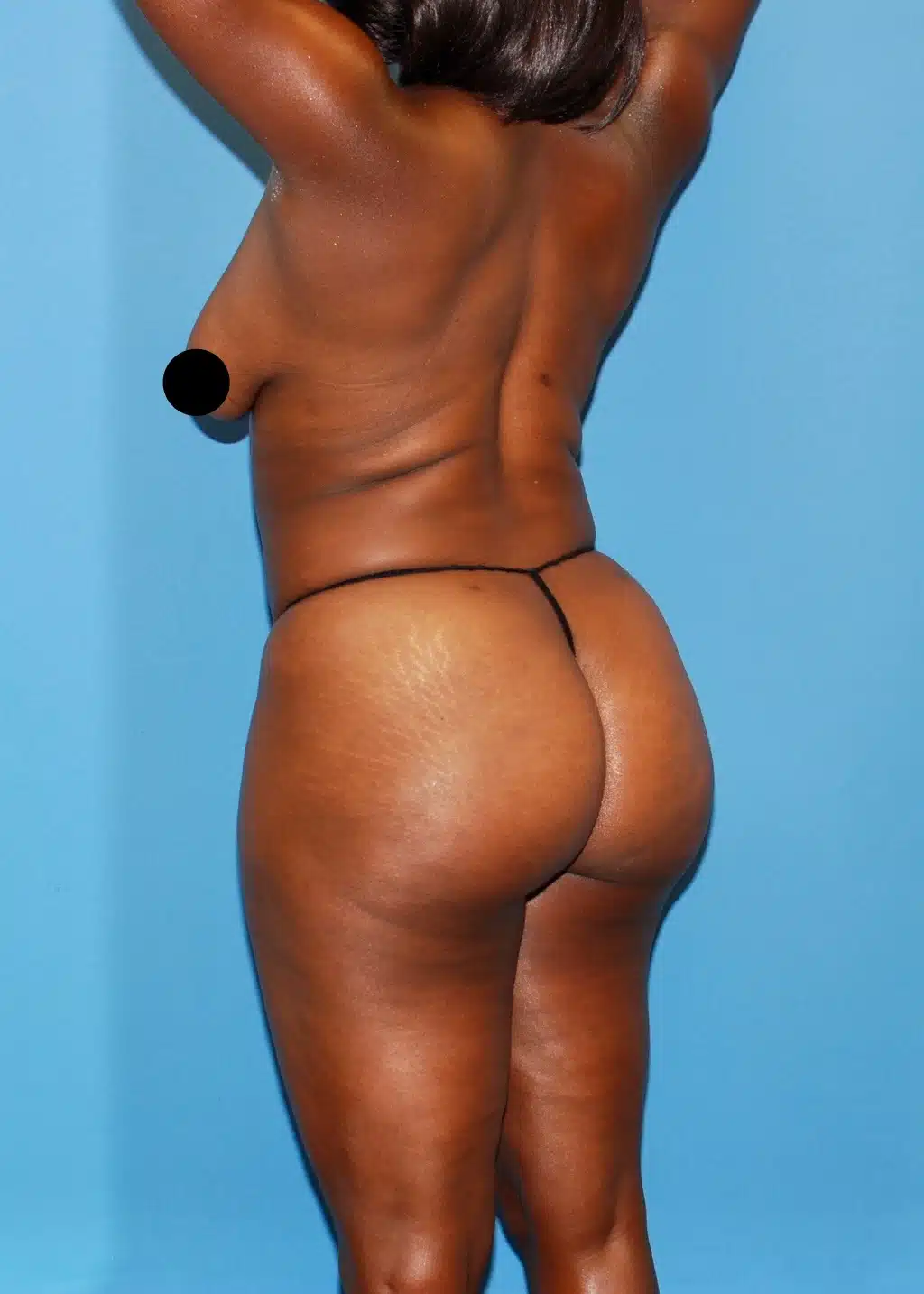 Brazilian Butt Lift, Lipo 360, Liposuction after photo 3, case #35511, Dr. Anh-Tuan Truong, Chicago Breast & Body