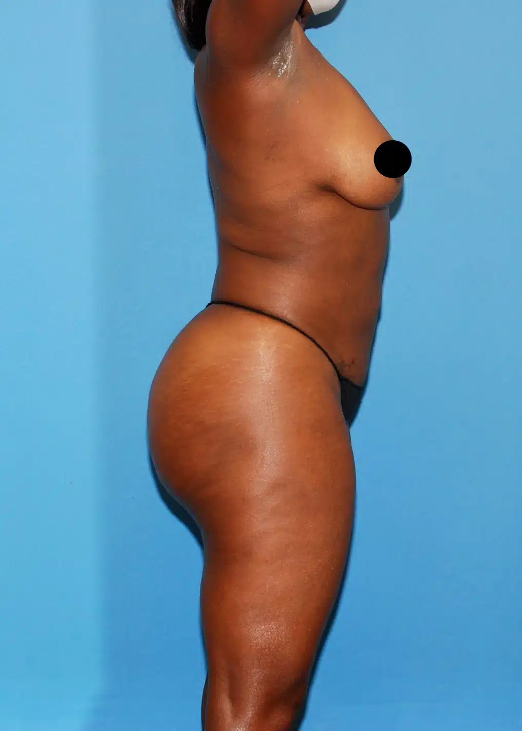 Brazilian Butt Lift, Lipo 360, Liposuction after photo 2, case #35511, Dr. Anh-Tuan Truong, Chicago Breast & Body