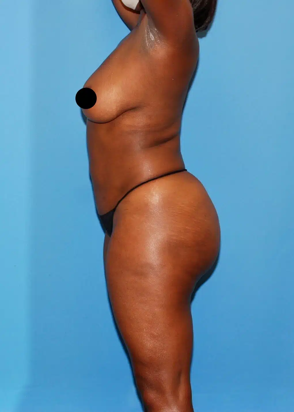 Brazilian Butt Lift, Lipo 360, Liposuction after photo 4, case #35511, Dr. Anh-Tuan Truong, Chicago Breast & Body