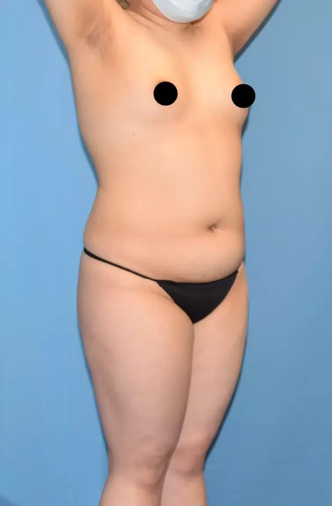 lipo360 before after chicago4.jpg