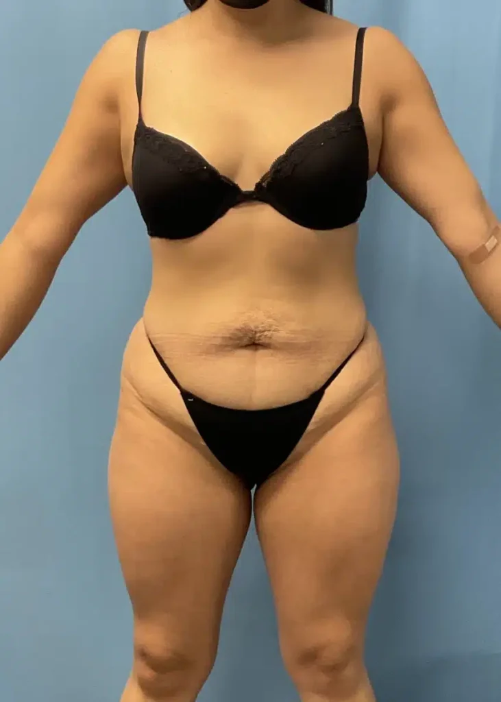 A woman in a bikini showing off her tummy for Case #2324, evaluated by Dr. Kevin Lin.