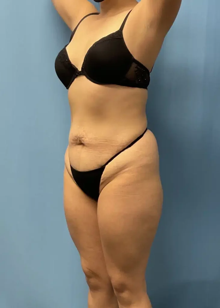A woman in a black bikini with a tummy tuck performed by Dr. Kevin Lin.