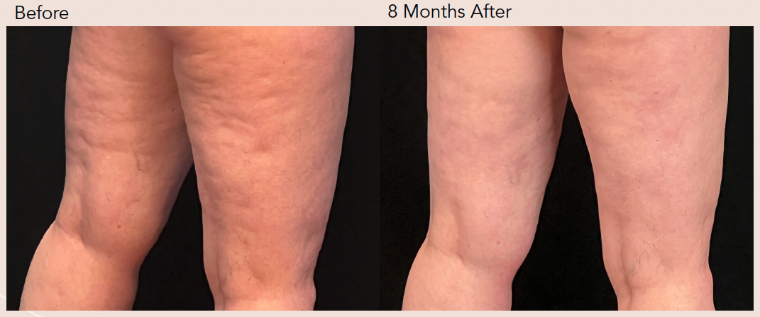 Before After Thighs Photo After Aveli Cellulite Treatment