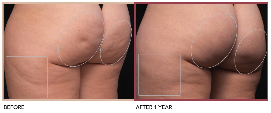Before and after photo after Aveli cellulite treatment