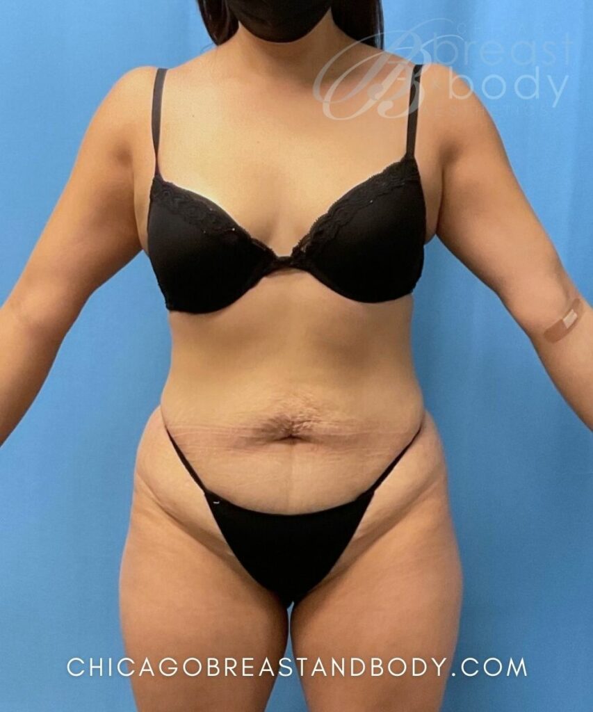Tummy Tuck with Liposuction Before After Photo Case 1830386 