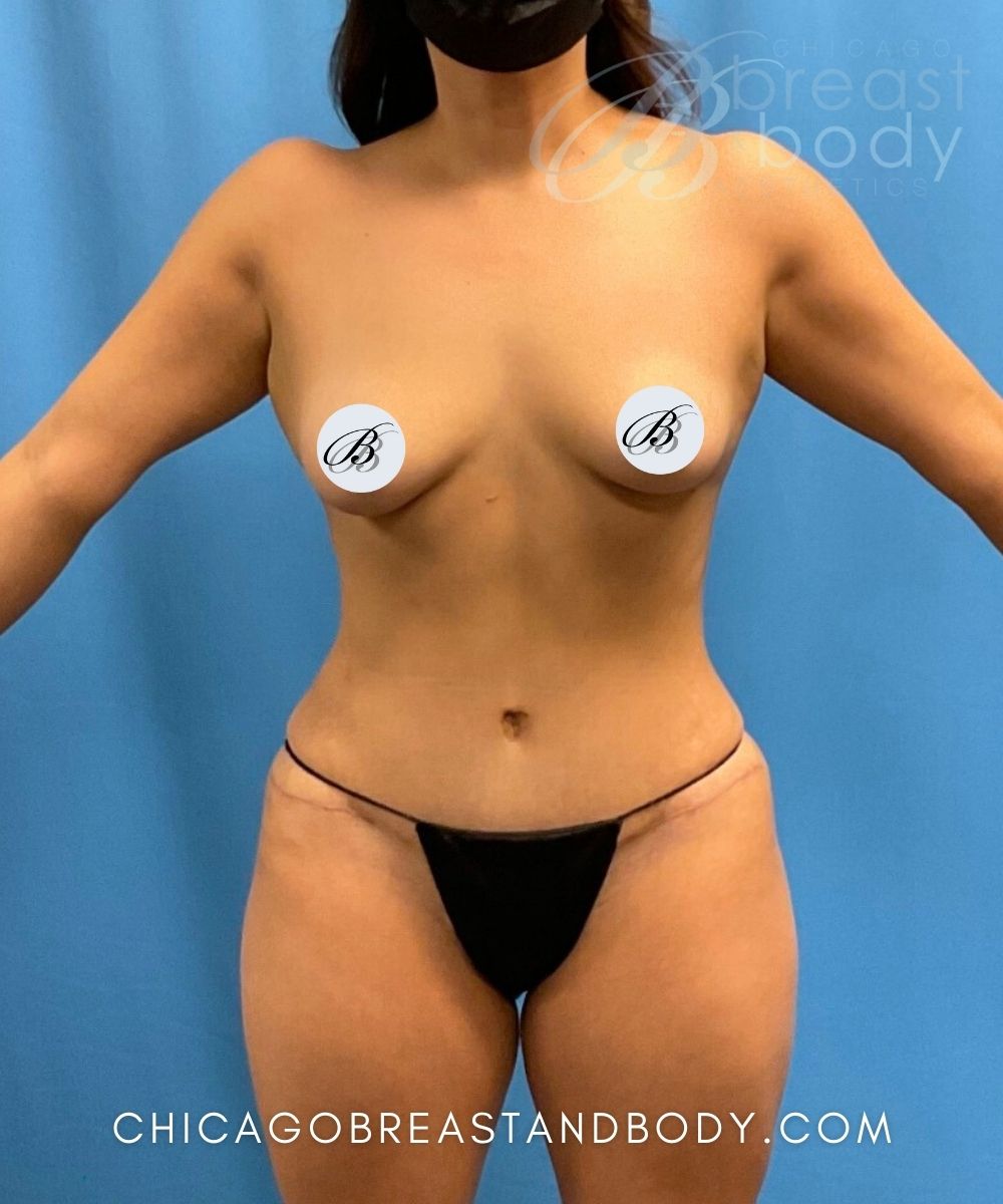 Chicago Breast and Body plus