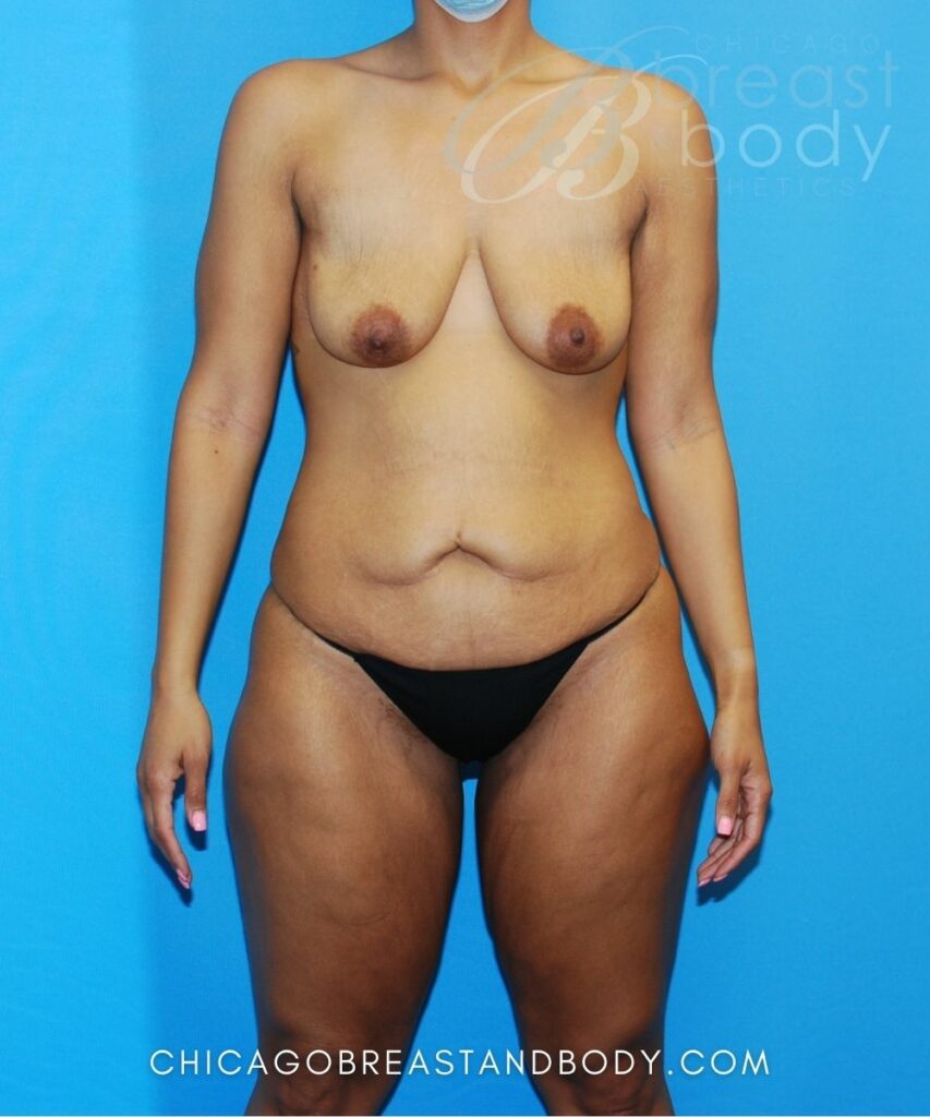 What Is A Mini Tummy Tuck?  Chicago Breast & Body Aesthetics
