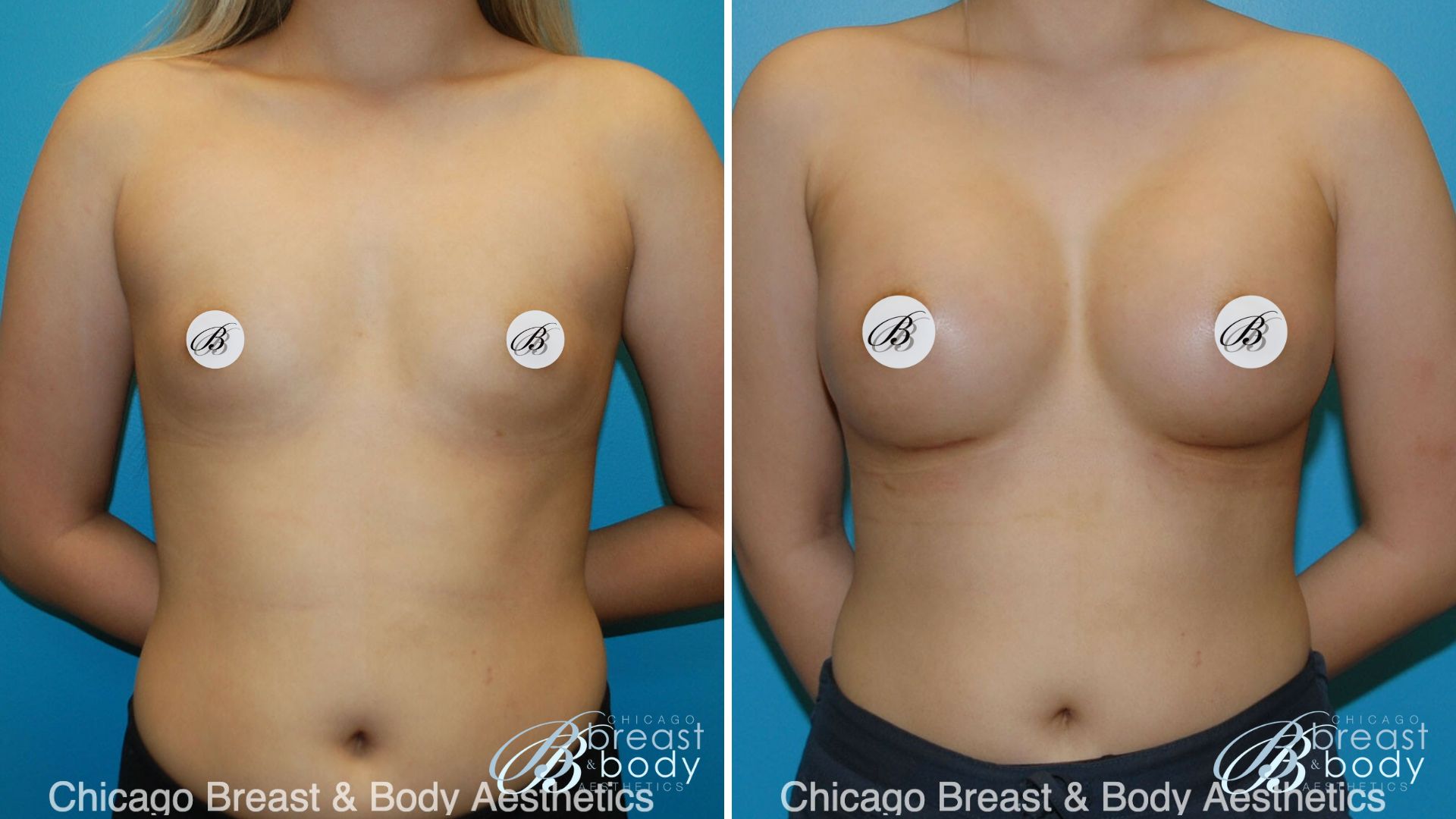 Breast Augmentation Price Cost Chicago3