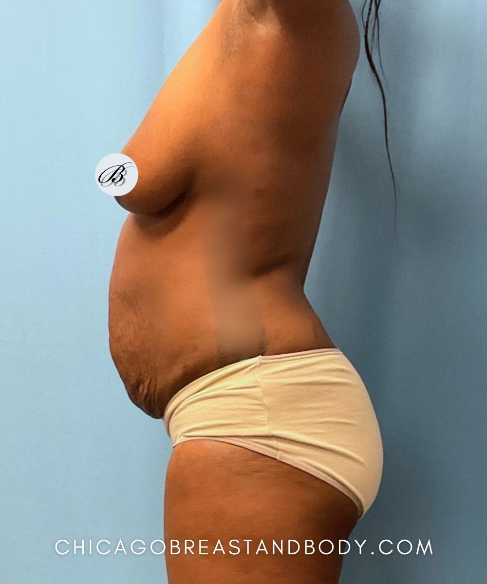 Lipoabdominoplasty (Tummy Tuck with Liposuction) before photo 3, case #1831262, Dr. Kevin Lin, Chicago Breast & Body