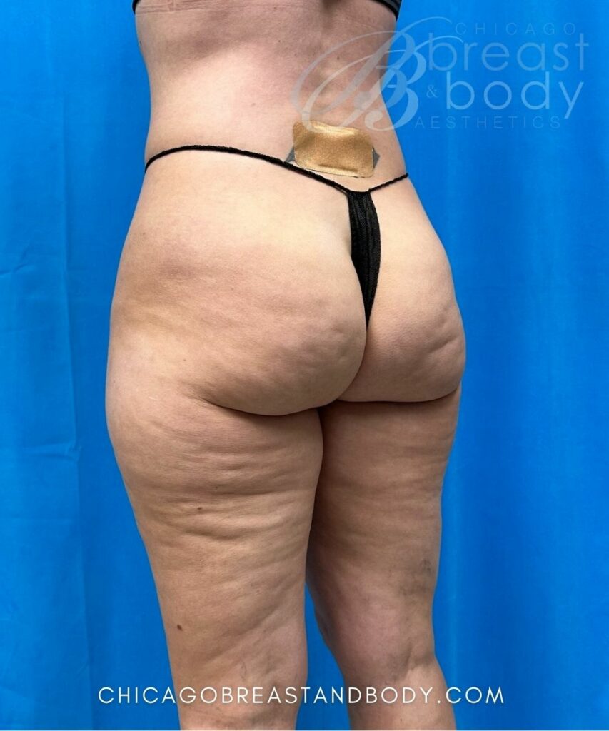 Aveli Cellulite Before After 2031107 Truong Chicago Breast and Body