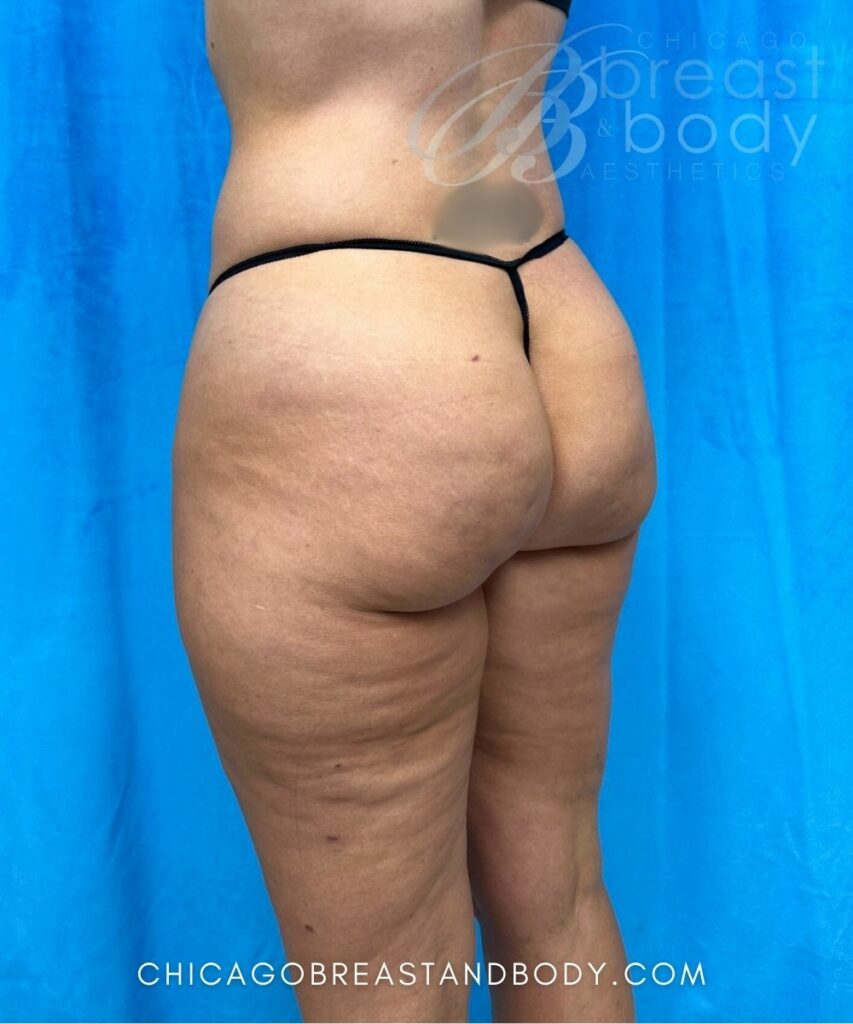 Aveli Cellulite Before After 2031107 Truong Chicago Breast and Body