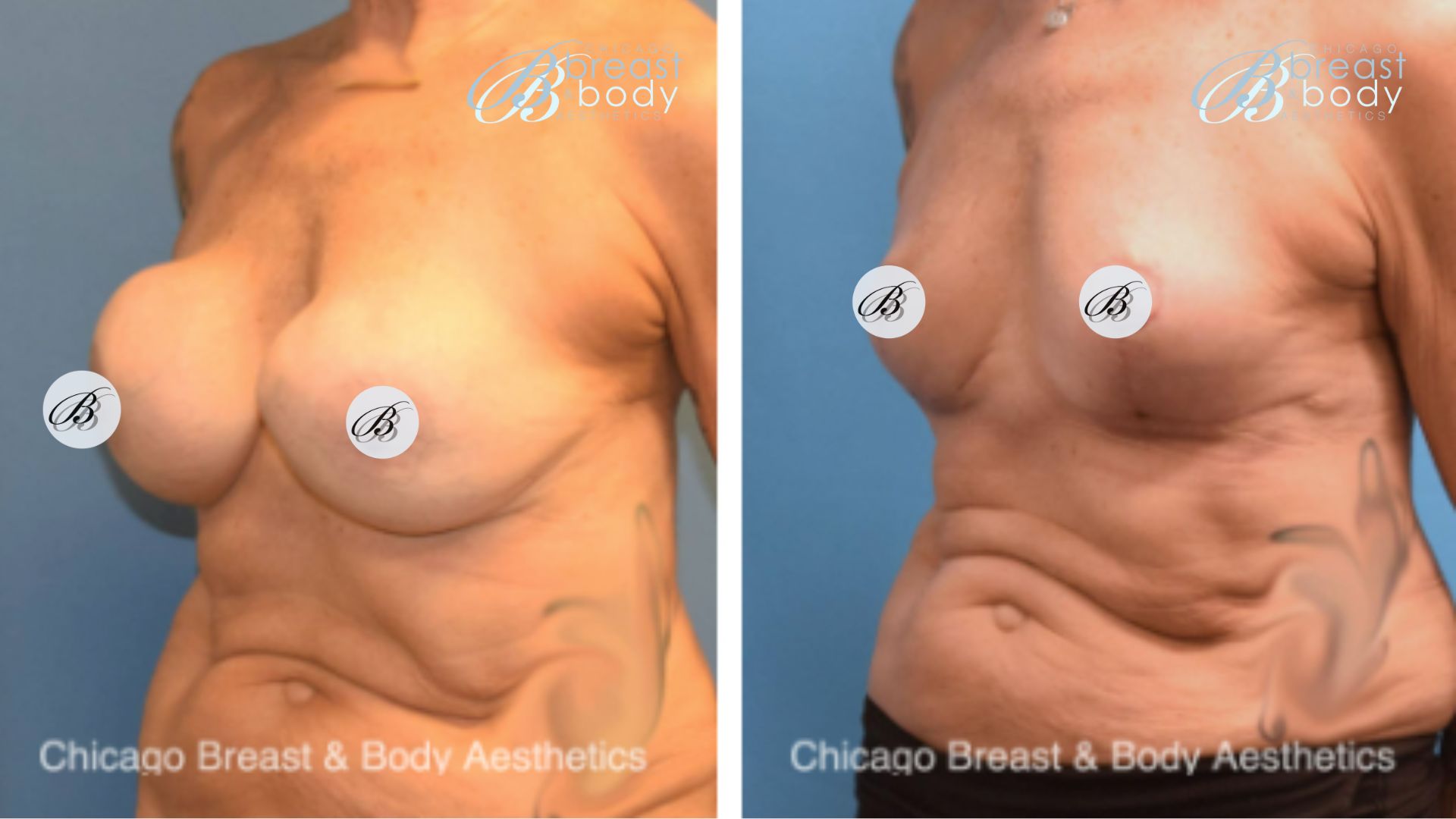 capsular contracture breast implant removal surgery before after photo by Chicago Breast and Body