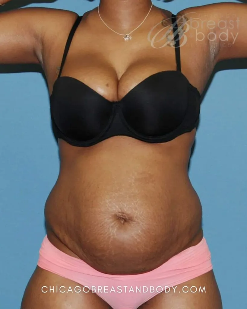 How Much Does A Tummy Tuck Cost In Chicago? | Chicago Breast And Body Aesthetics Tummy Tuck Before After by Chicago Breast & Body Aesthetics