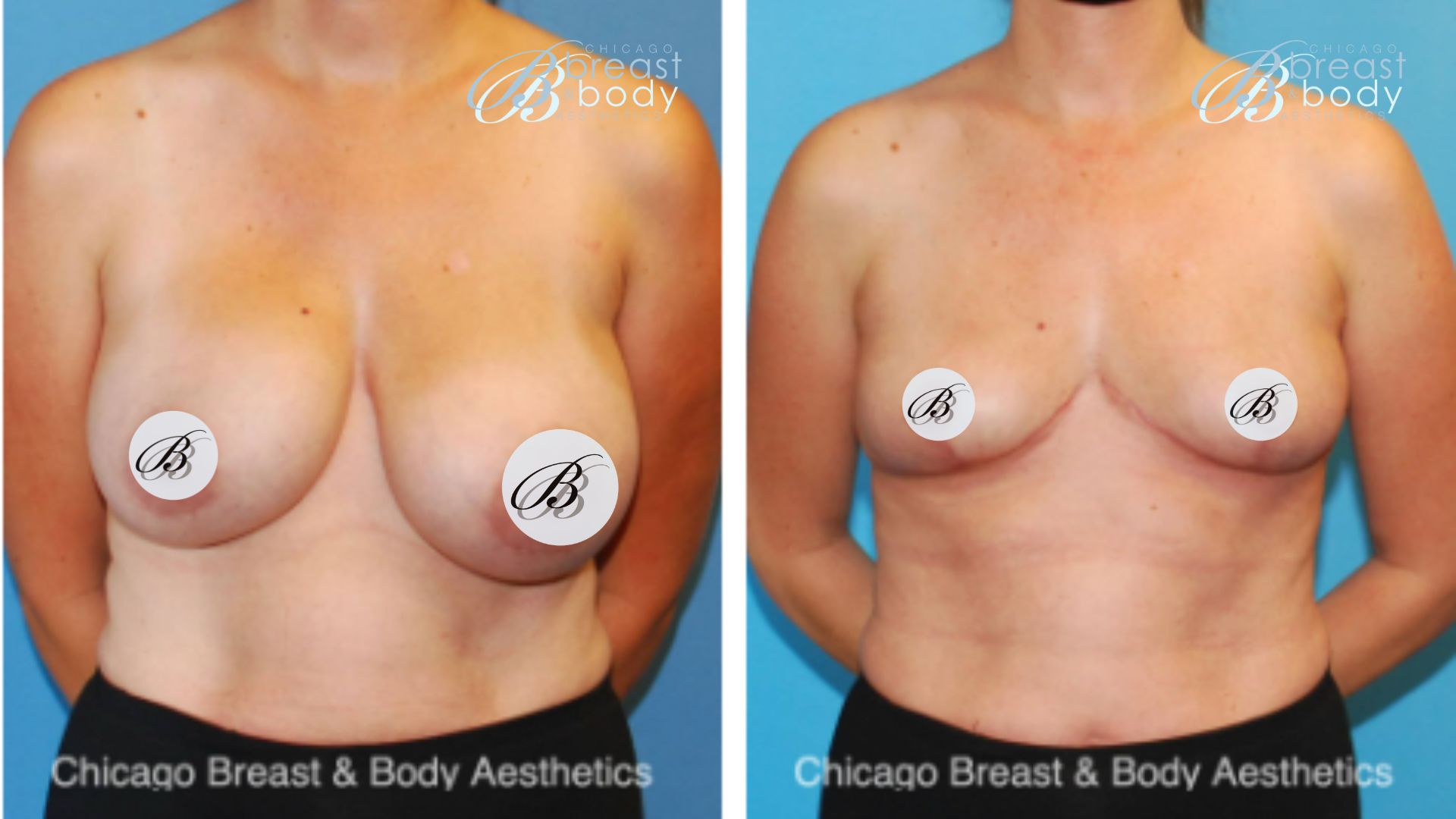 Saline breast implant removal surgery before after Chicago Breast and Body