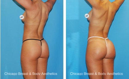 Natural BBL Before After Photos Chicagobreastandbody0