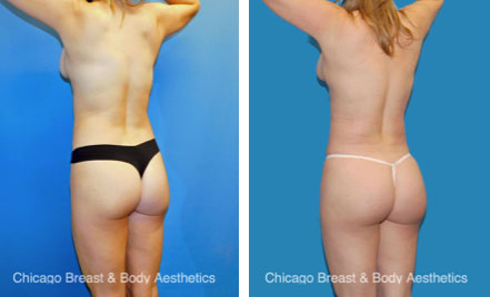 Natural BBL Before After Photos Chicagobreastandbody4