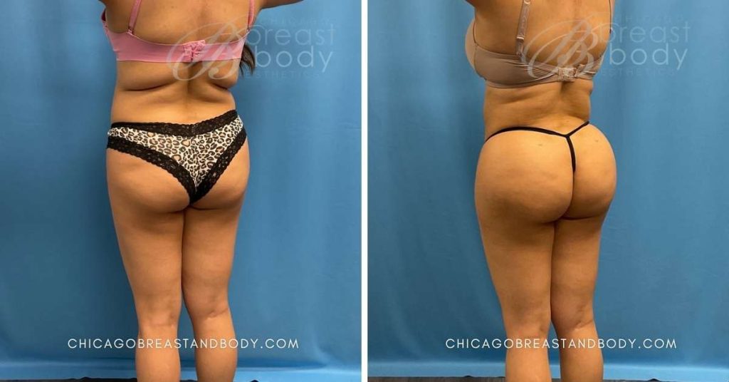 1829935 Before After Brazilian Butt Lift Chicago Dr. Kevin Lin