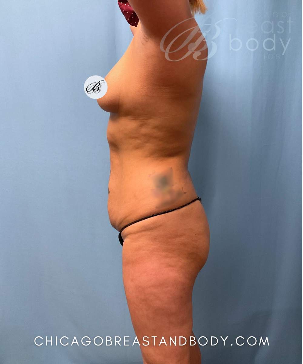Brazilian Butt Lift, Lipo 360 before photo 2, case #1767958, Dr. Kevin Lin, Chicago Breast & Body