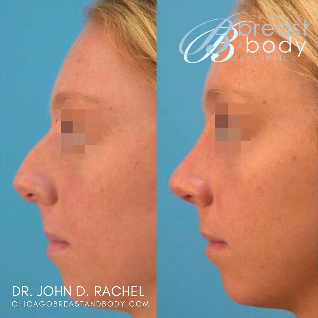 Rhinoplasty Surgery Before After by Dr. John Rachel Chicago 1