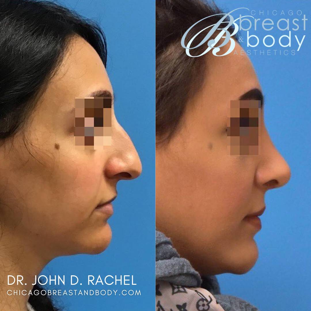Rhinoplasty Surgery Before After by Dr. John Rachel Chicago 2