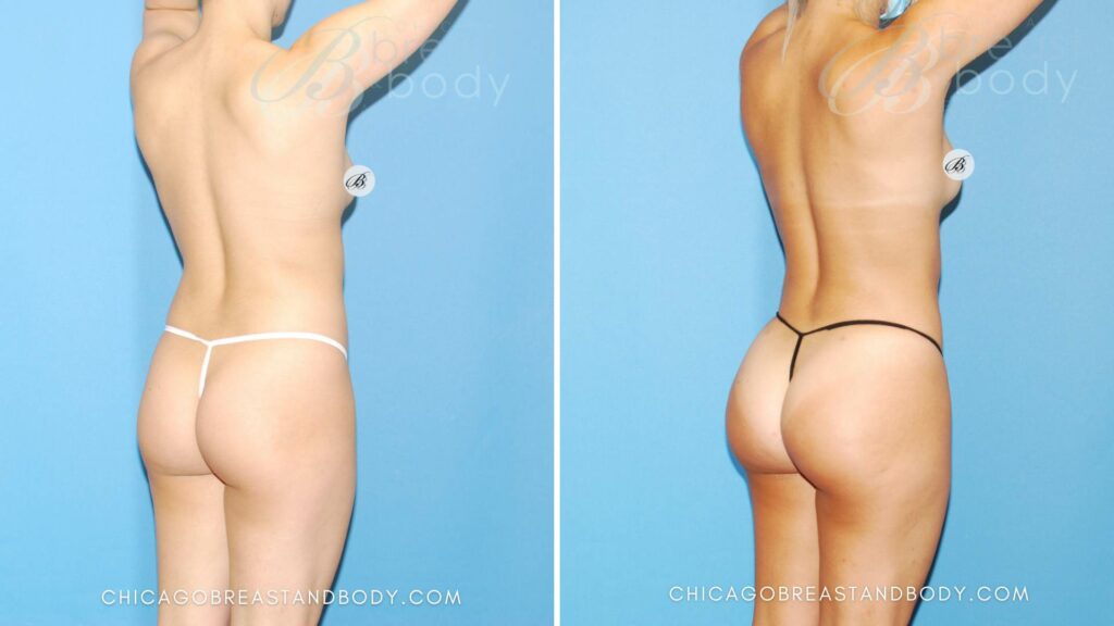 how much does brazilian butt lift surgery cost