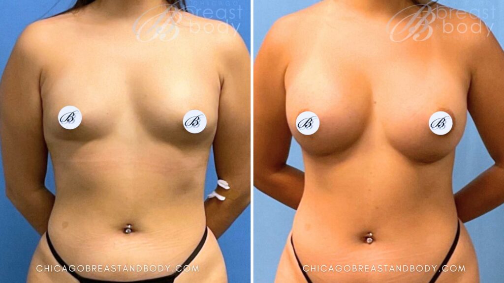 6 Decisions for your Breast Augmentation Surgery Chicago Breast & Body Aesthetics