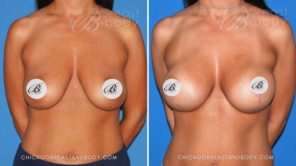 6 Decisions for your Breast Augmentation Surgery Chicago Breast & Body Aesthetics