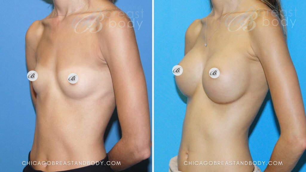 6 Decisions for your Breast Augmentation Surgery Chicago Breast & Body Aesthetics