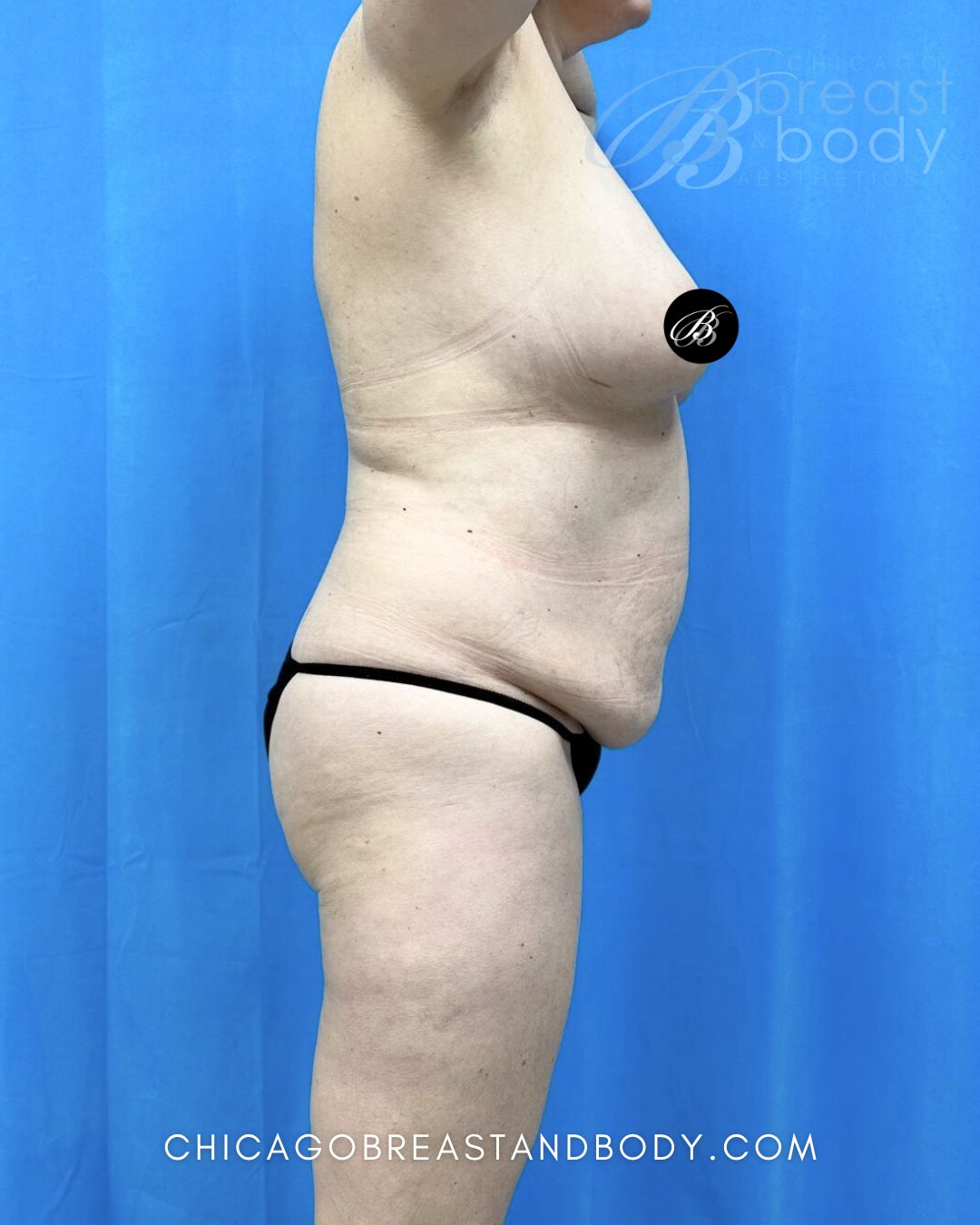 Abdominoplasty (Tummy Tuck), Lipoabdominoplasty (Tummy Tuck with Liposuction) before photo 3, case #2208334, Dr. Anh-Tuan Truong, Chicago Breast & Body