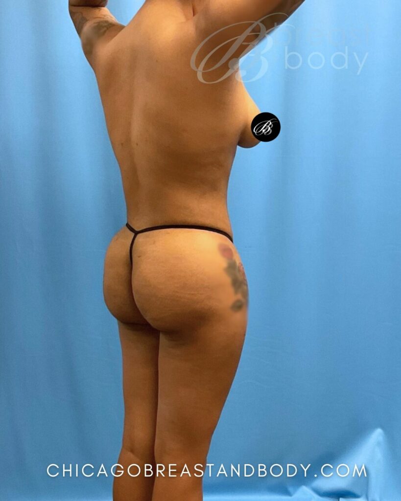 1907491 BBL with Lipo 360 by Dr. Kevin Lin Chicago Breast and Body 3mo