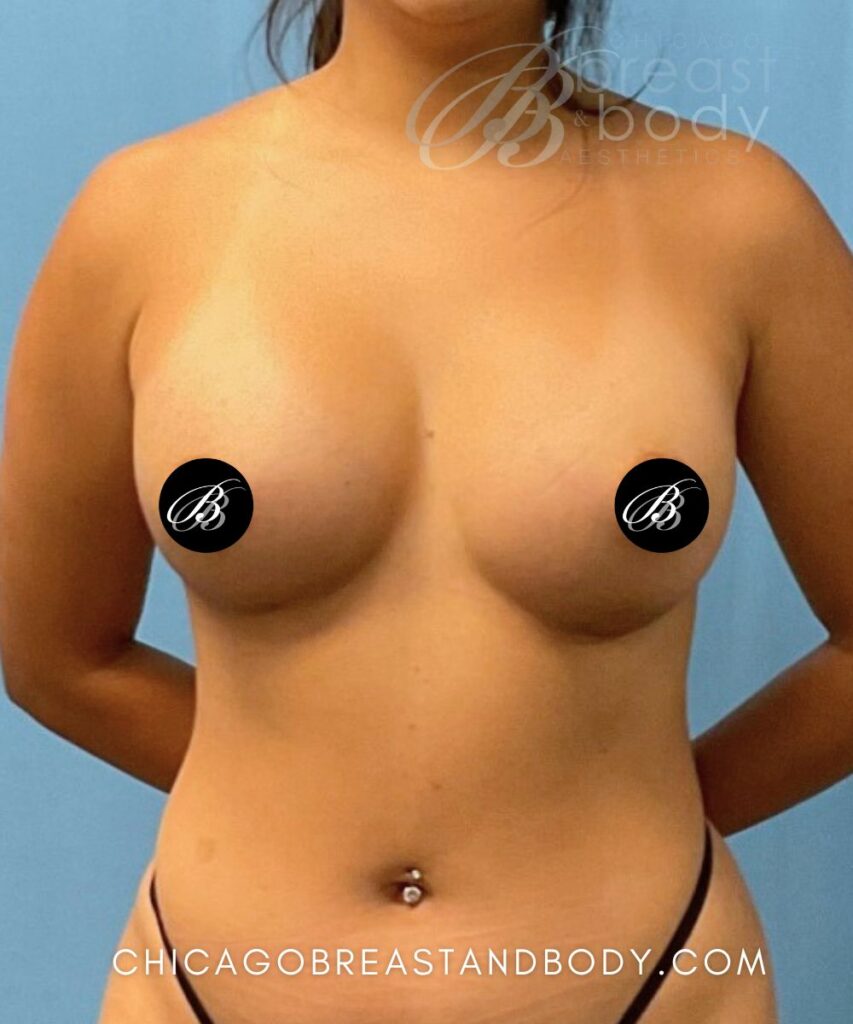 1975784 Breast Enhancement 400cc HP 4mo by Dr. Kevin Lin Chicago