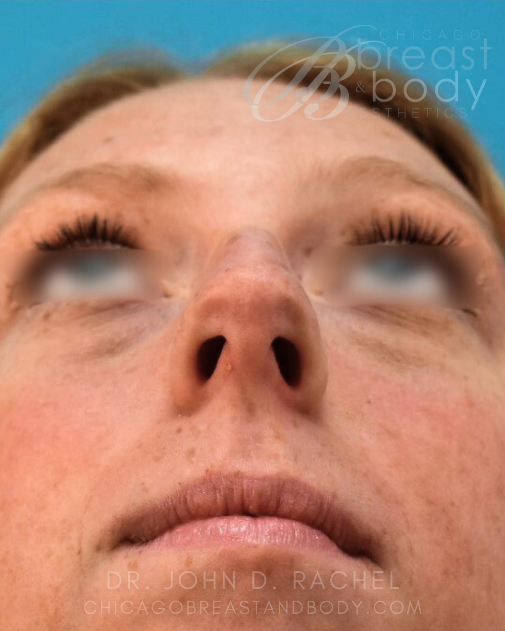 Rhinoplasty before photo 2, case #930241, Dr. John Rachel, Chicago Breast & Body