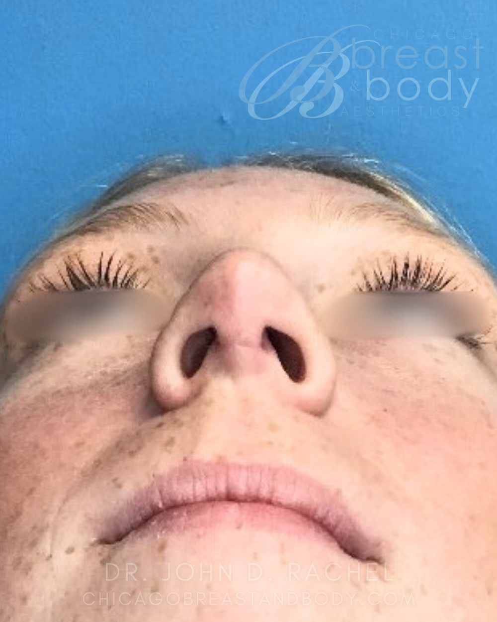 Rhinoplasty after photo 2, case #930241, Dr. John Rachel, Chicago Breast & Body