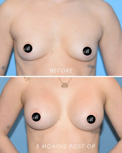 1988239 Breast Augmentation by Dr. Anh Tuan Truong 3mo