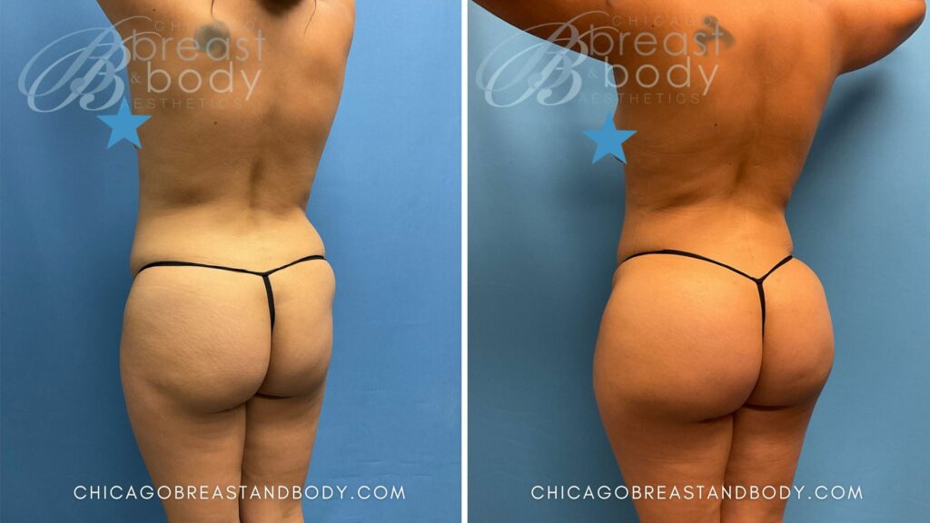 Brazilian Butt Lift by Dr. Kevin Lin