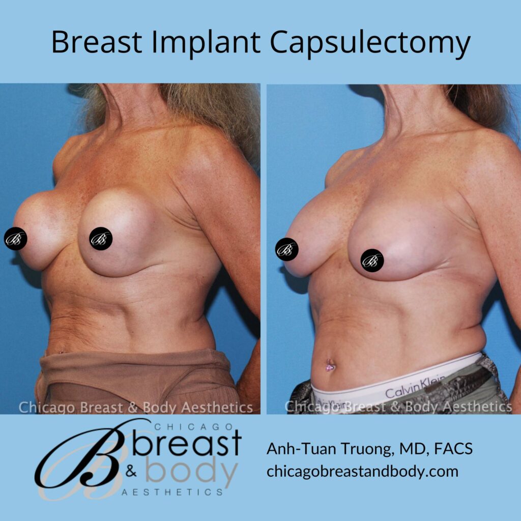 what is a breast implant capsulectomy?