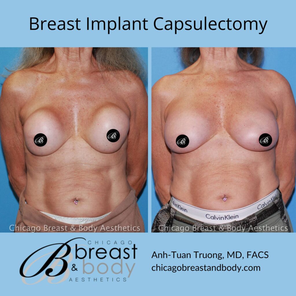 what is a breast implant capsulectomy?