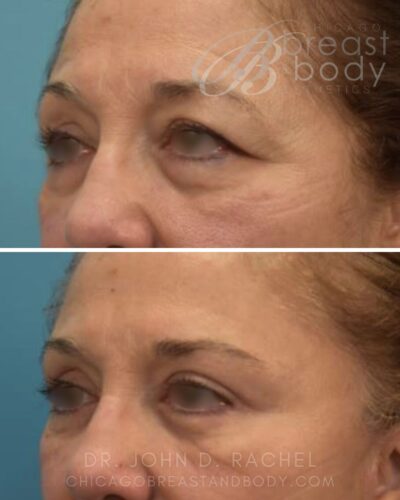 1001242 Blepharoplasty by Dr. John Rachel Chicago