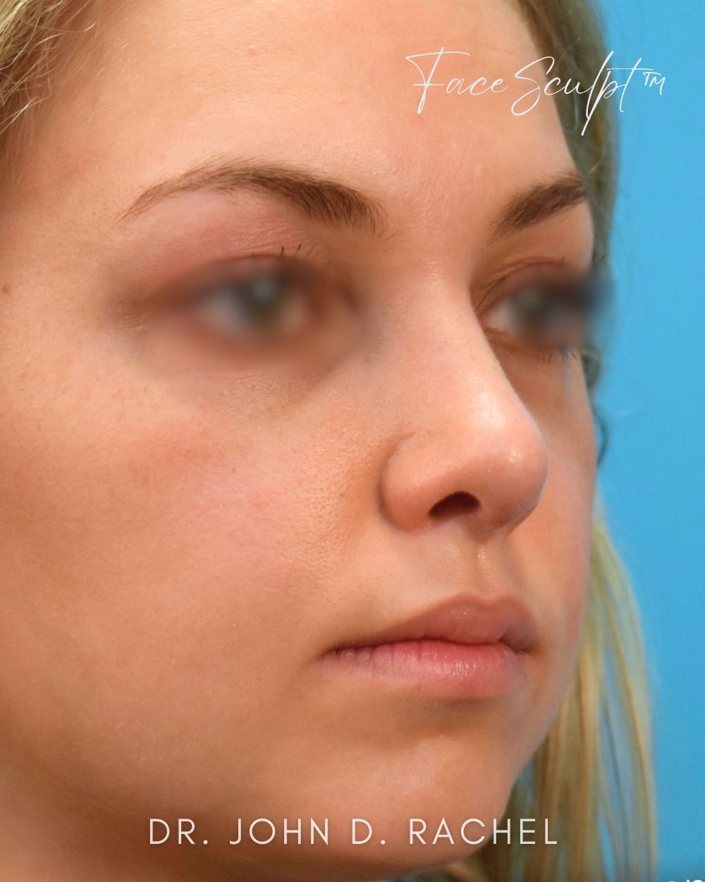 Rhinoplasty after photo 2, case #1029243, Dr. John Rachel, Chicago Breast & Body
