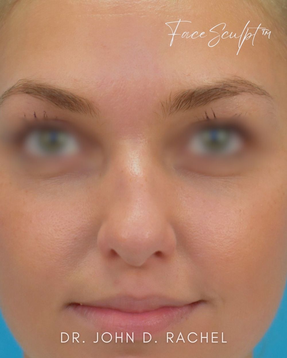Rhinoplasty before photo 3, case #1029243, Dr. John Rachel, Chicago Breast & Body