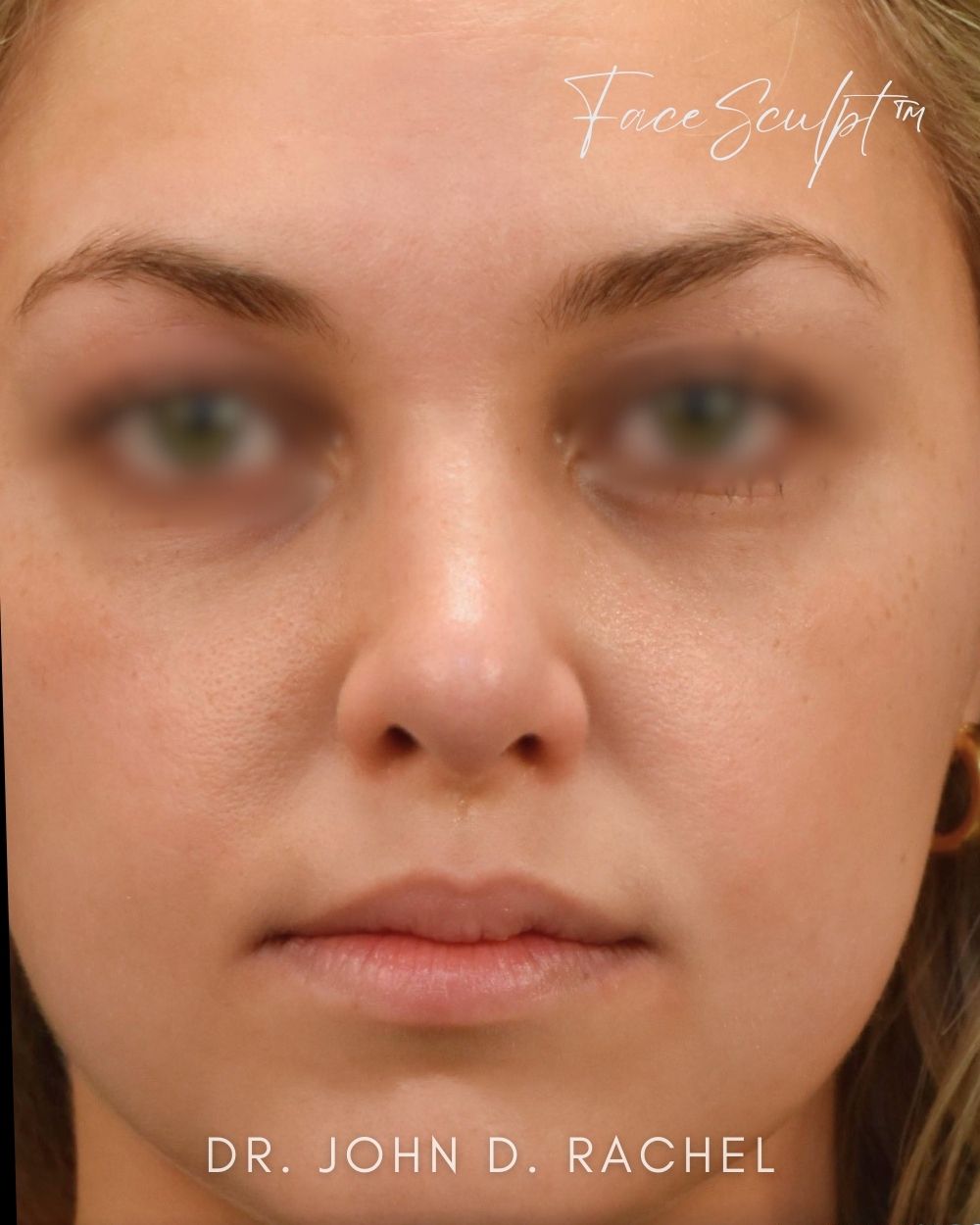 Rhinoplasty after photo 3, case #1029243, Dr. John Rachel, Chicago Breast & Body
