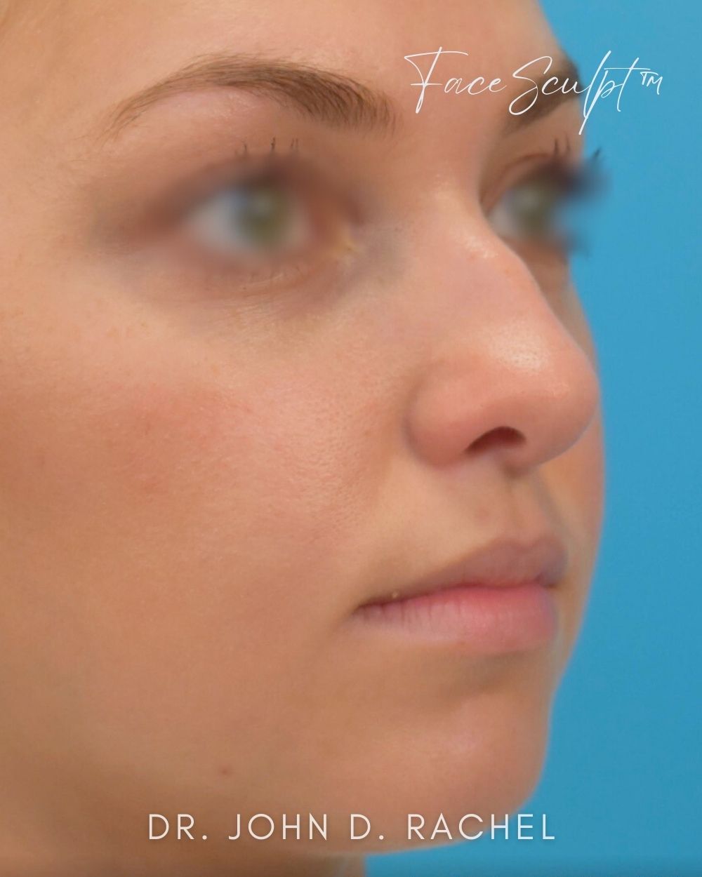 Rhinoplasty before photo 2, case #1029243, Dr. John Rachel, Chicago Breast & Body