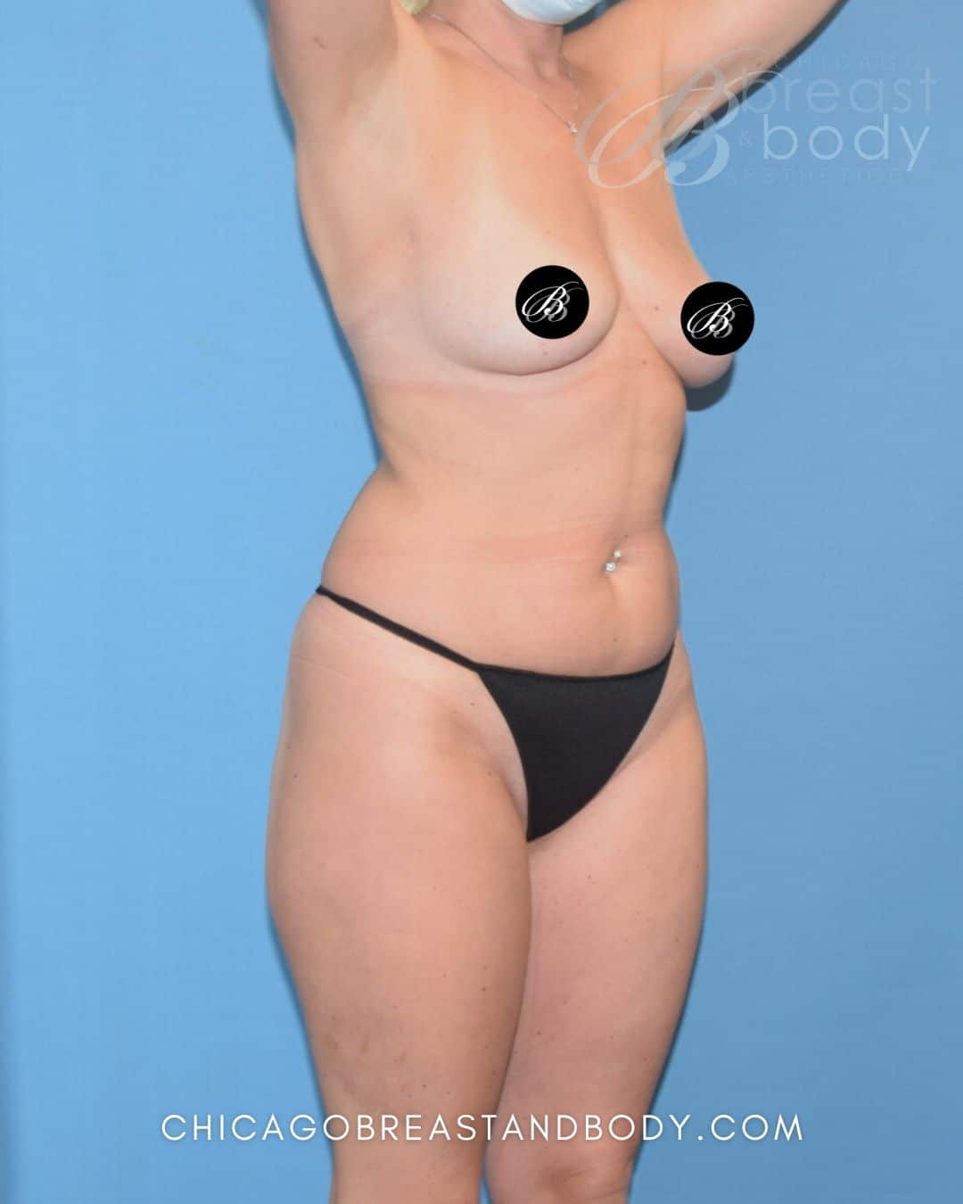 Hip Augmentation, Lipo 360, Skinny BBL before photo 6, case #1748544, Dr. Anh-Tuan Truong, Chicago Breast & Body